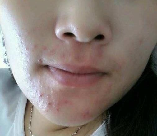 晨起脸上有这3个表现，不好意思，百万螨虫大军在脸上“做窝”了