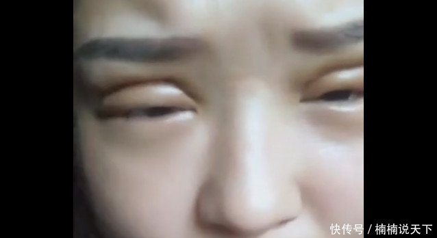 刚割完双眼皮的脸，你确定是在变美让人有些不忍直视！