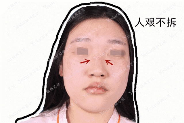 实锤：国民闺女，整容了？