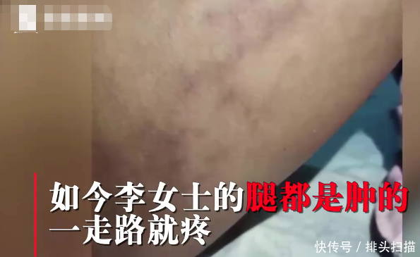  #填充#脸太瘦不旺夫？女子花4万整容，腿部抽脂填充脸，结果留下4个坑