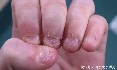 坦言■自小爱啃指甲的孩子,长大后会怎样医生坦言一般都是两种结局