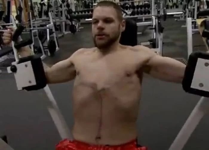 体重600多斤的小伙，疯狂减掉400斤，结果皮肤竟变成了这样！