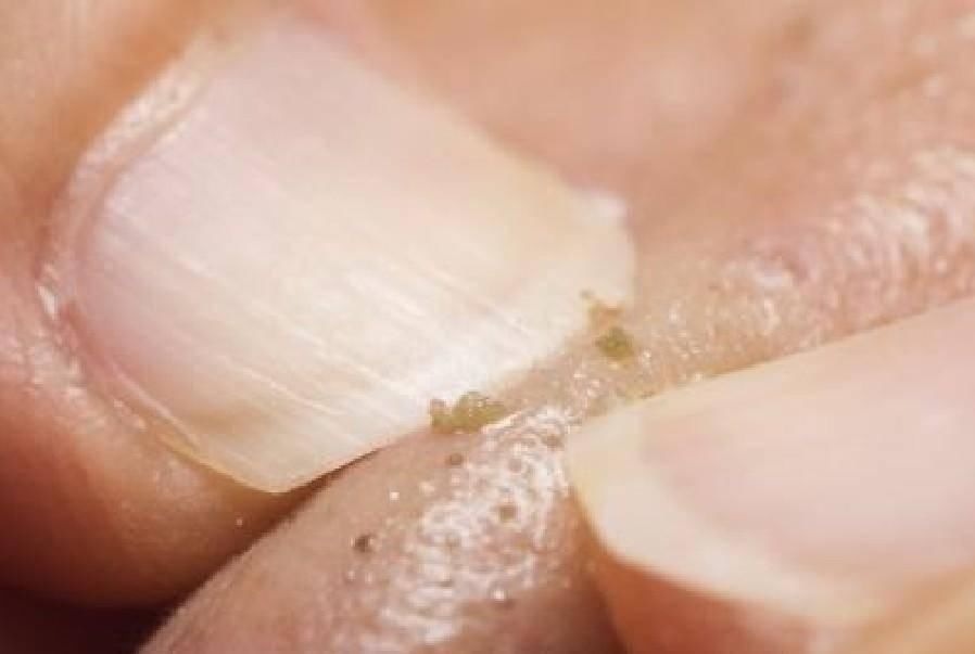 鼻子上挤出来的东西，分好几种，你知道几种呢?