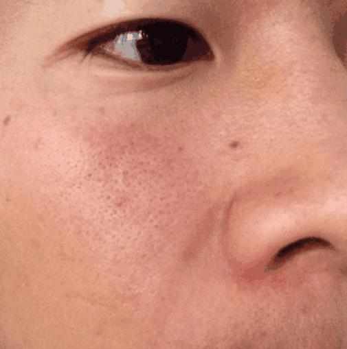 螨虫“聚积”毛孔，脸上4个部位会说话，3方法自测揪出