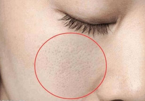 螨虫号称“皮肤田鼠”，脸上到底有没有，对照4道螨虫题一侧便知