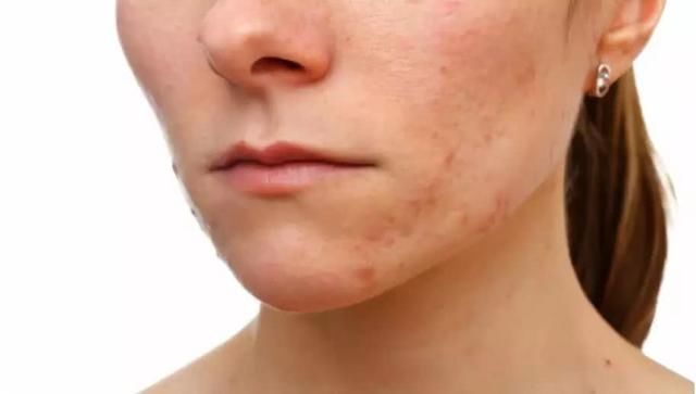 关于去黑头的皮肤管理知识！黑头不能挤？