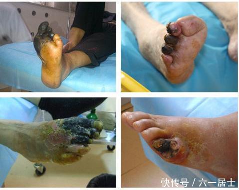 什么是糖尿病足干性坏疽