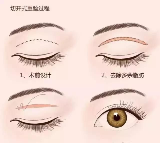  「上睑下垂」除了割双眼皮，还能如何改善自己的眼睛？