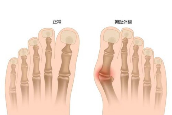  『外翻』怎么预防拇指外翻好啊?