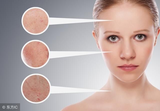 这样的痘痘肌9年了，能好吗？3个月好了，你信吗？