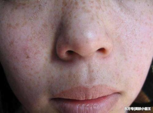 大蒜加“它”, 一周皮肤淡斑紧肤, 去皱增白让你年轻不止5岁