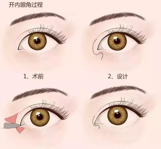  「上睑下垂」除了割双眼皮，还能如何改善自己的眼睛？