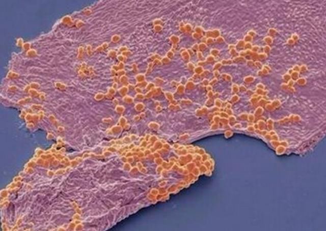 脸上螨虫成灾怎么办?用这一招，螨虫全都死光光