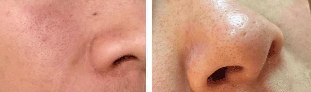 小清新的“脸部吸尘器”，10分钟铲掉你脸上黑头、粉刺、角质!