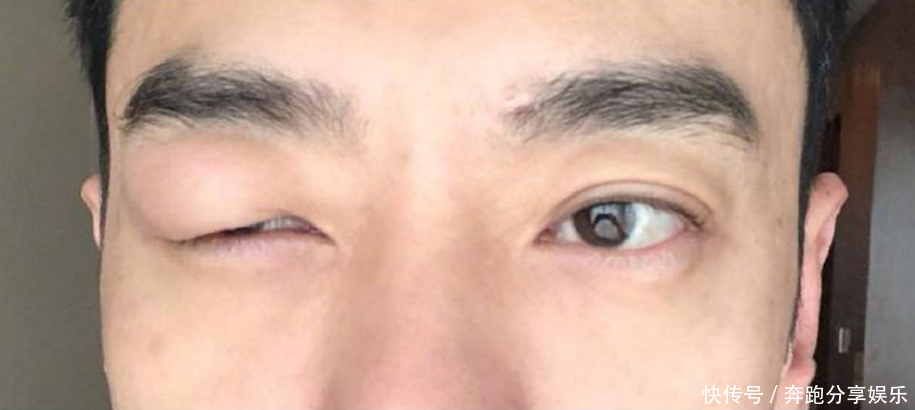 李光洁被蚊子咬引发“工伤”，全剧组因此停工，网友知道真相后大