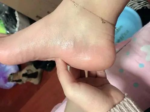  【体无完肤】27岁女孩，脚裂用掉十几把修脚锉，变得体无完肤，干裂日益严重