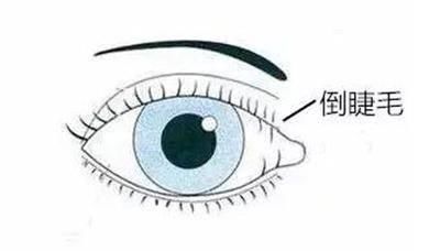 解决■双眼皮手术原来不止能变美,还能解决这么多问题