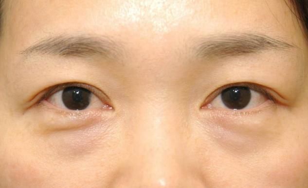 『女性』分不清“卧蚕”和“眼袋”?专家告诉你区别在哪,女性了解下
