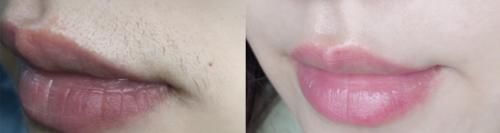  #术后恢复#为什么说春季是医美旺季？最适合整形项目大盘点，必看！