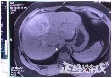 PDD乐观对待病情称“还好是上单抗压MAX”!女友怒斥造谣!