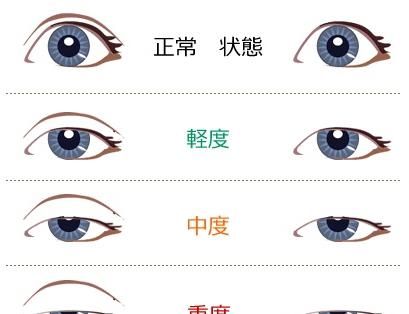 「眼部」双眼皮除了好看,还能改善哪些眼部问题?