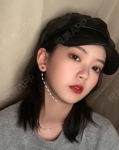  角度■我的下额角磨骨后形成第二个角度,这算不算磨骨失败?