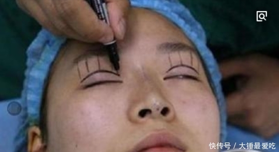 #影响#手术割了双眼皮的人,老了之后有什么影响?看完真要留意了