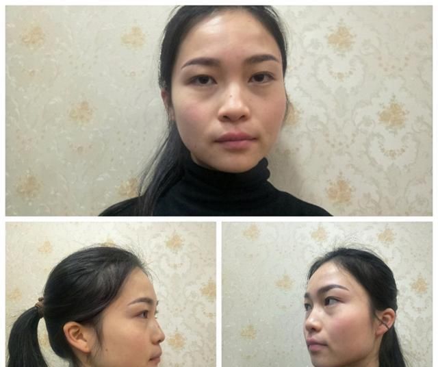  #术后#隆鼻真的有用吗？鼻综合术后六个月记录，这完全不是一个人！