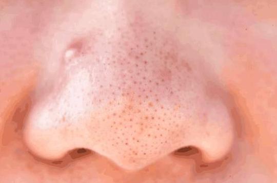 三伏天痘痘频发, 出现3个症状要警惕了, 毛孔可能被螨虫堵住了