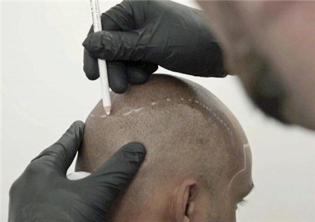 男子请纹身师在头顶纹头发，效果令人大跌眼镜