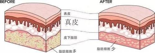  难度：吸脂手术分部位解析吸脂难度和后遗症发生可能