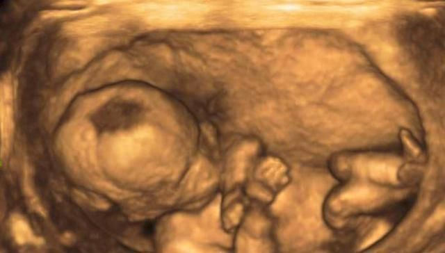 做四维彩超检查@孕期,做“四维彩超”时能看出宝宝性别或许聪明孕妈都能看明白