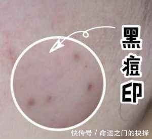 宿系■长年痘印也不怕——认清痘印类型,宿系之源还你光滑肌