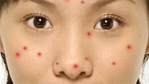 脸上毛孔里“堆满”了螨虫，皮肤会有3反常，2方法拎出来