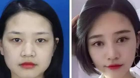 一双眼睛毁掉整张脸，这几种眼睛做双眼皮美爆了，有你没有？