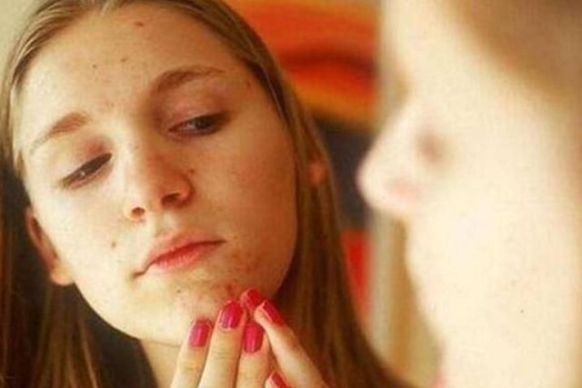 许多人不知道螨虫怕什么，3招皮肤变成“无痘肌”