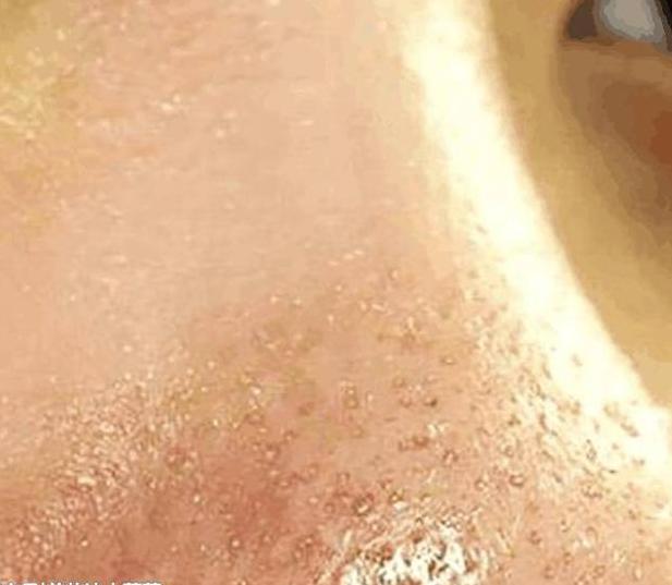 螨虫号称“皮肤田鼠”，脸上到底有没有，对照4道螨虫题一侧便知