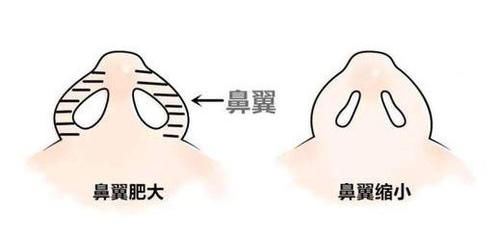  [医生]鼻翼缩小手术安全吗？有什么需要注意的？
