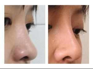 做假体隆鼻费用大概需要多少