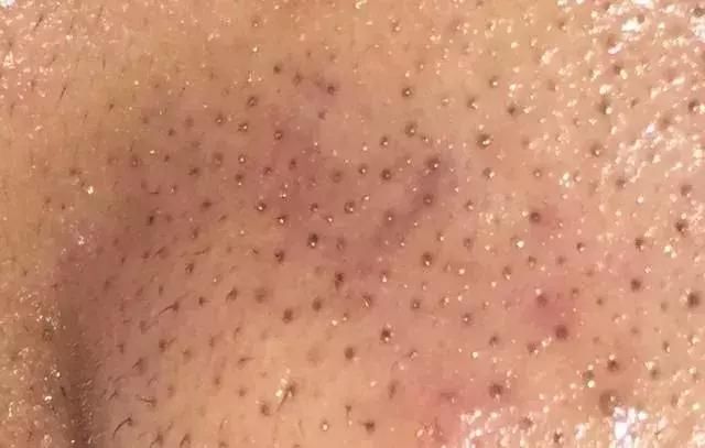 草莓鼻必看！一喷一抹，轻松把黑头分解掉！