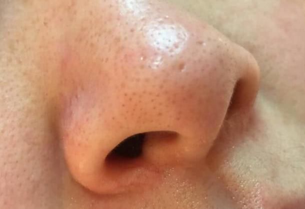 鼻头里挤出这么多“小黄粒”,证明脸上螨虫过亿，3招教你逼退螨虫