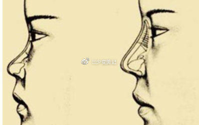  『鼻翼软骨』那么哪些鼻型适合做隆鼻手术