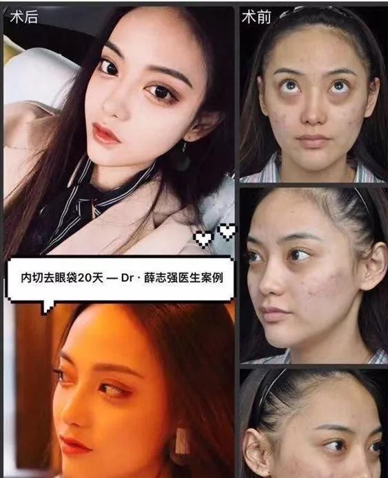  [熬夜]明明说好一起熬夜的，为什么就只有你熬出了眼袋+黑眼圈？
