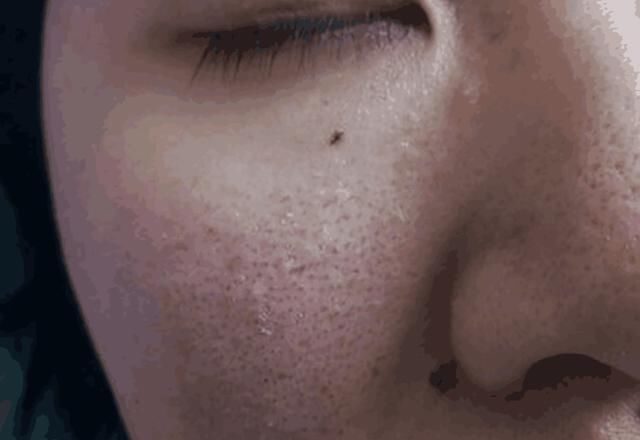 脸上有4个浮现，说明毛孔螨虫“多如牛毛”, 陨灭螨虫只需2招