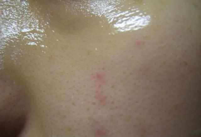 不管男女生，脸上出现3迹象，说明被螨虫缠上，3招把螨虫一窝端