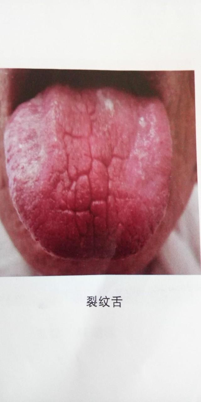 舌有齿痕湿气重吃啥药（齿痕舌怎么治疗最有效）