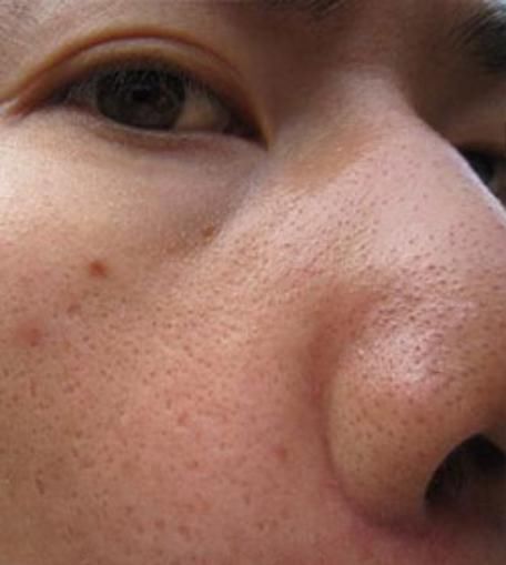 毛孔粗大的朋友有救了！竟然用3招就能拥有零毛孔，知道晚了