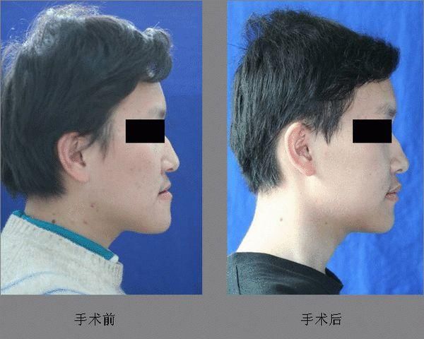 “整牙到底能不能瘦脸”终于有了权威结论,杨幂竟是被冤枉的?