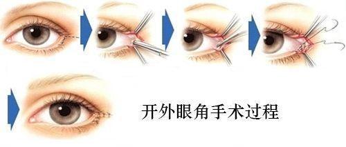 内眦赘皮:眼睛小怎么办?是开内眼角好还是开外眼角好?