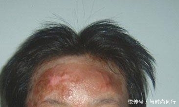  烧伤■烧伤疤痕修复手术多少钱